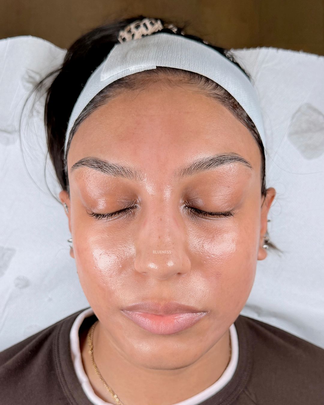 Acne scarring and hyperpigmentation, Fitzpatrick 4/5 — treated at Blueness London — after