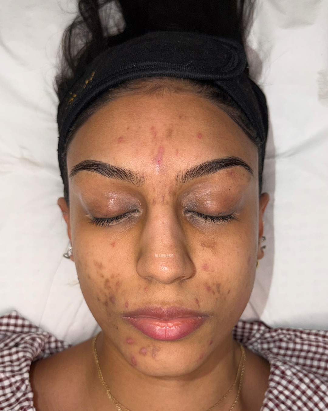 Acne scarring and hyperpigmentation, Fitzpatrick 4/5 — treated at Blueness London — before